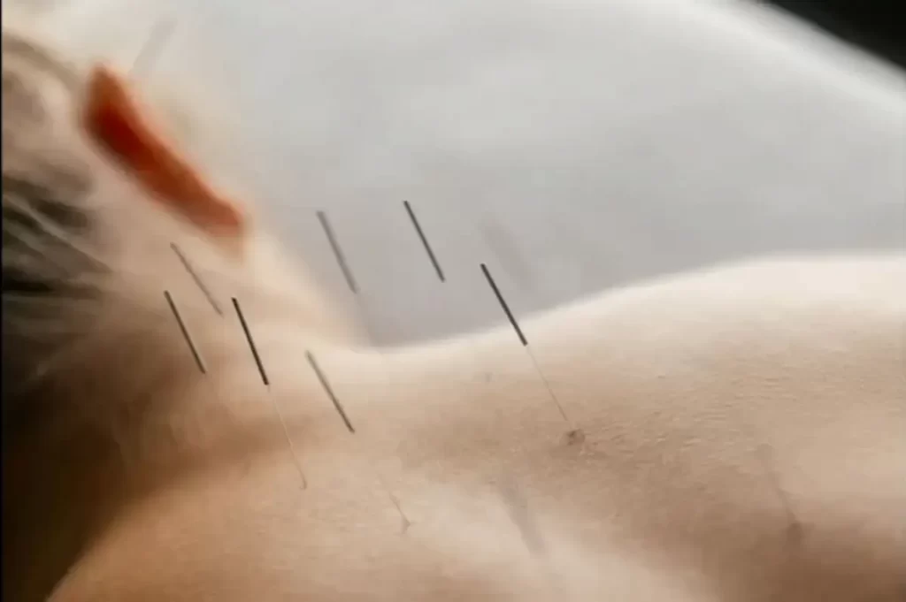 Acupuncture for Chronic Pain relief targeting deep muscle tension and nerve sensitivity in the back.