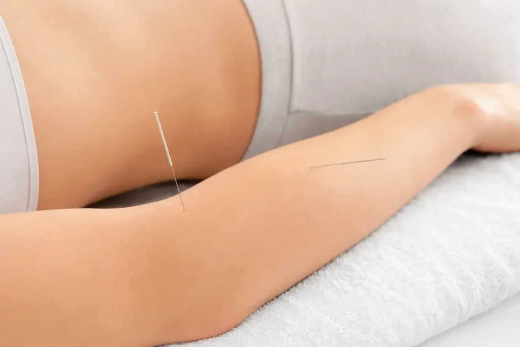 How Much Does Acupuncture Cost on Long Island? A 2026 Pricing Guide for Setauket 1 Close-up of acupuncture needles inserted into the forearm during tennis elbow treatment to reduce pain, inflammation, and muscle tension naturally.