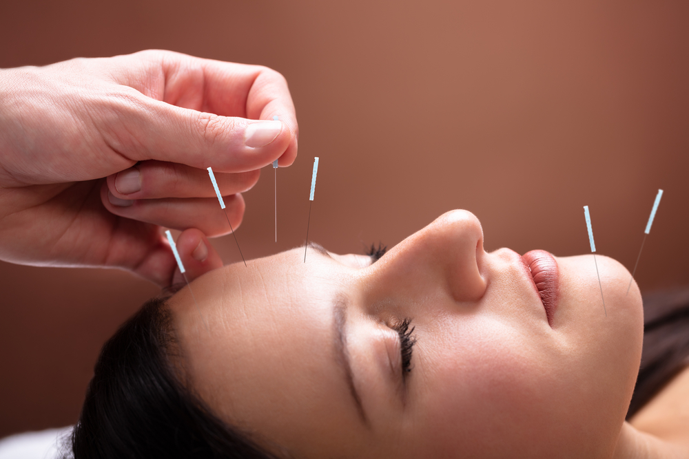 Exploring The Effectiveness Of Dry Needling For Migraines