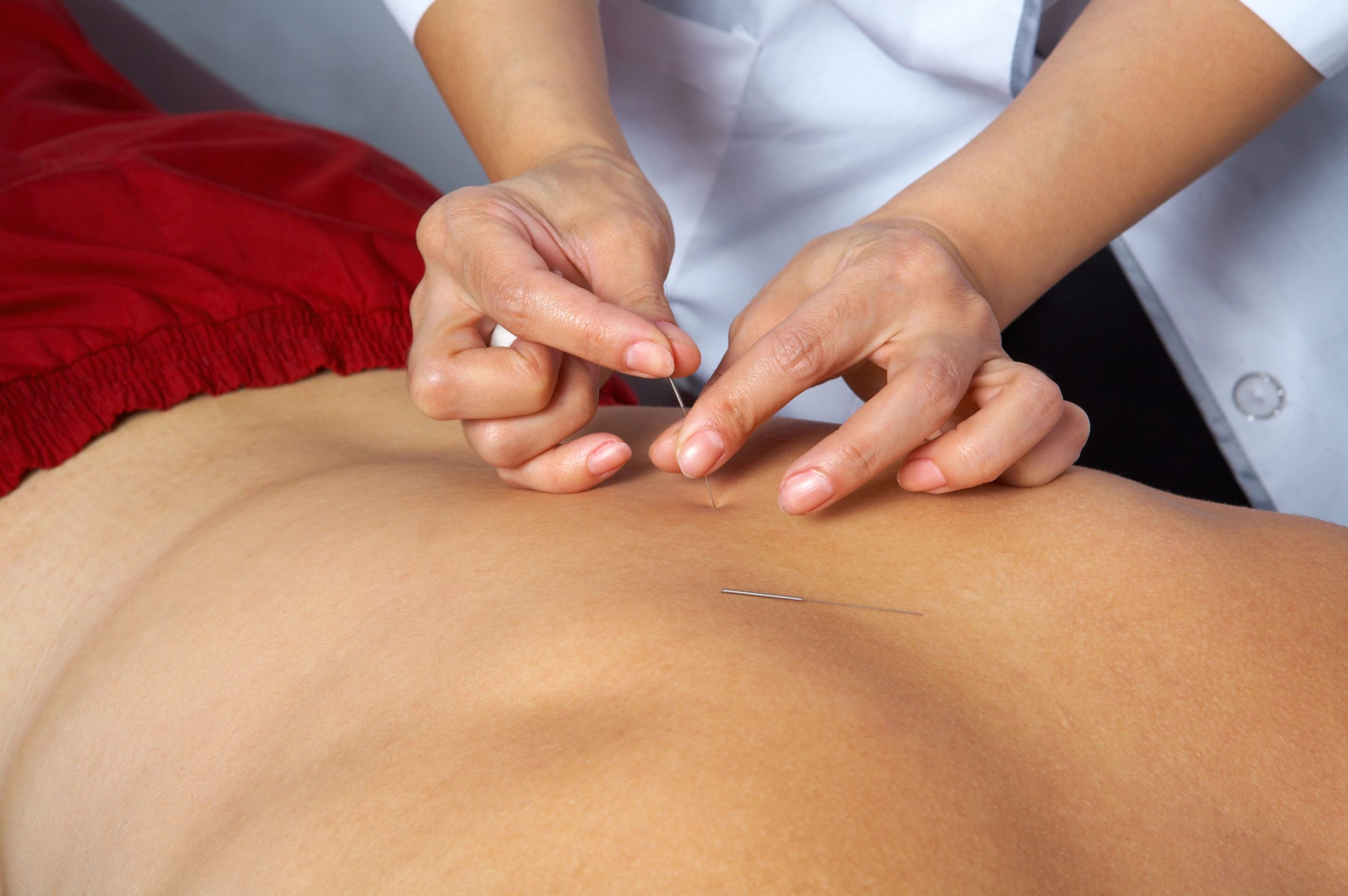 Dry Needling Vs. Acupuncture Which Therapy Suits Your Needs