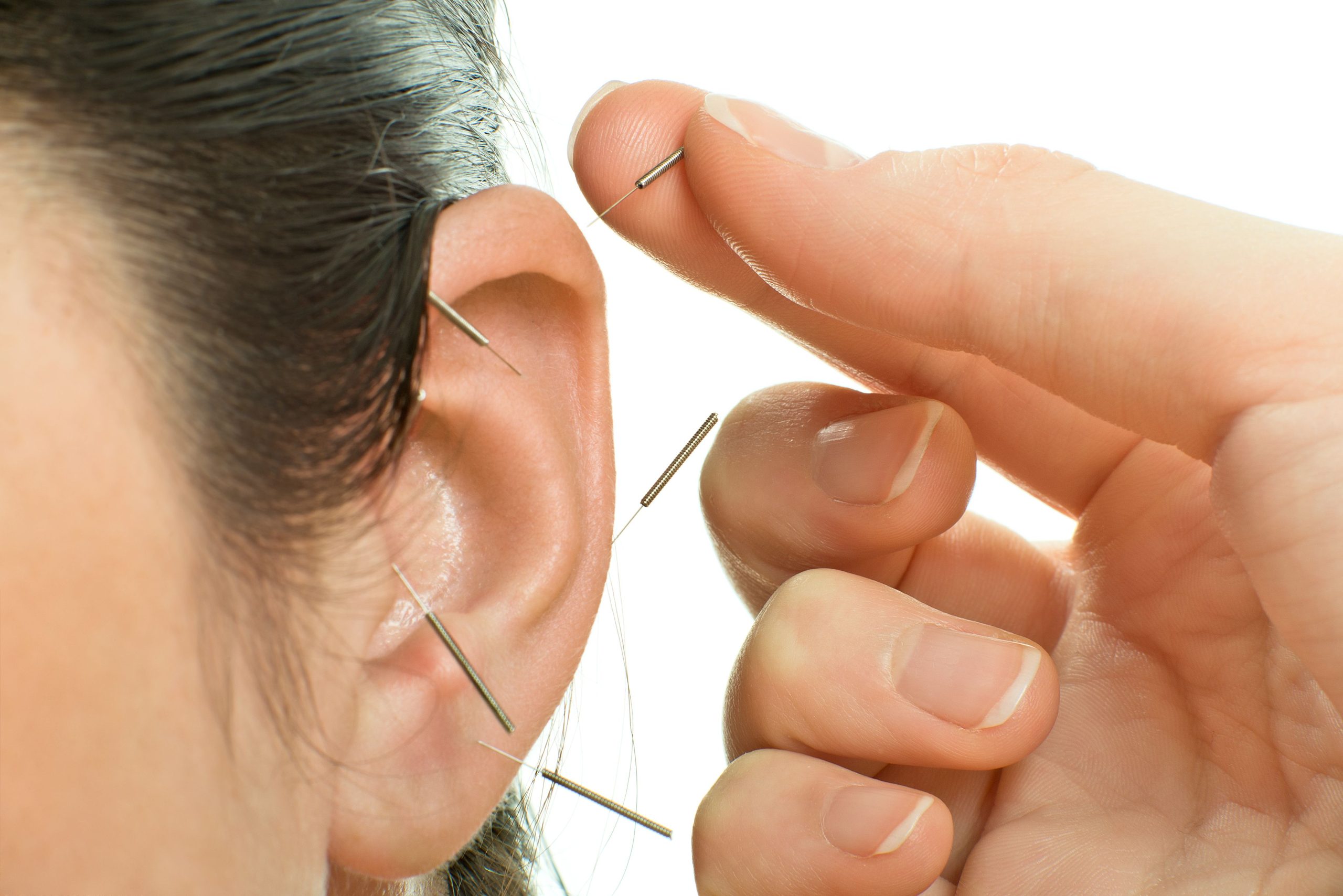 Ear Acupuncture A Guide To Its Healing Potential1