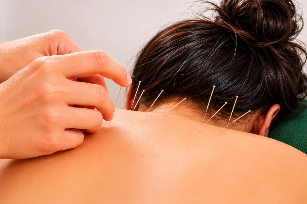 Patient receiving acupuncture for seasonal allergies treatment in a wellness clinic
