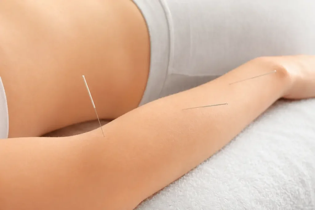 Acupuncture for Sports Injuries: A Summer Recovery Guide 1 Close-up of acupuncture for sports injuries recovery