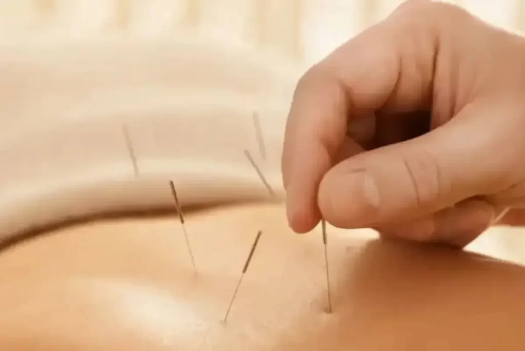 Close-up of acupuncture needles inserted into a person's lower back during a post-acupuncture treatment session for back pain.