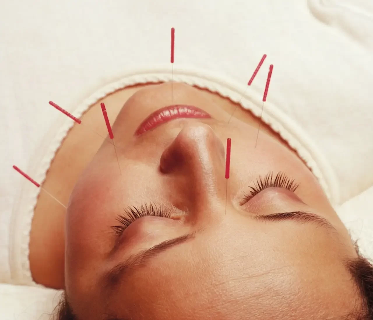Overhead view of a relaxed woman receiving facial acupuncture with several thin needles placed along her cheeks and forehead for holistic healing.