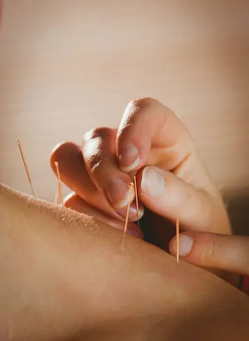 Close-up of acupuncture needles being applied to a patient’s arm