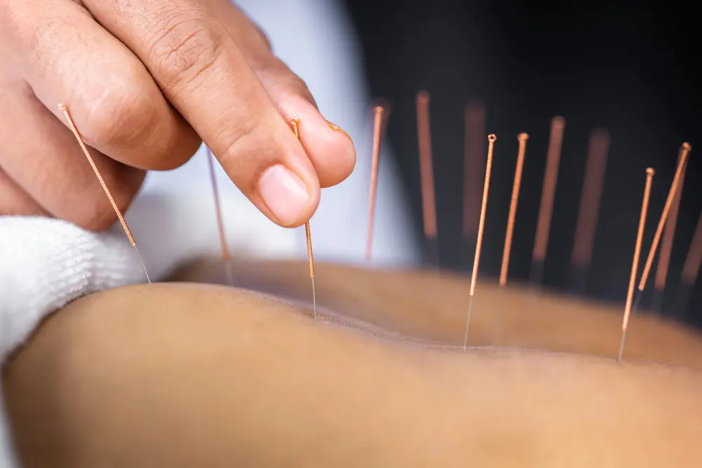 Close-up of copper-handled acupuncture needles inserted in the back for pain relief in East Setauket NY