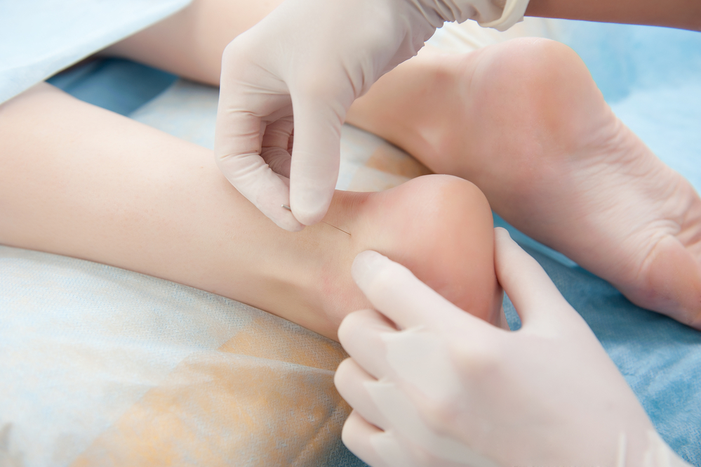 Acupuncture For Plantar Fasciitis: How Does It Work?