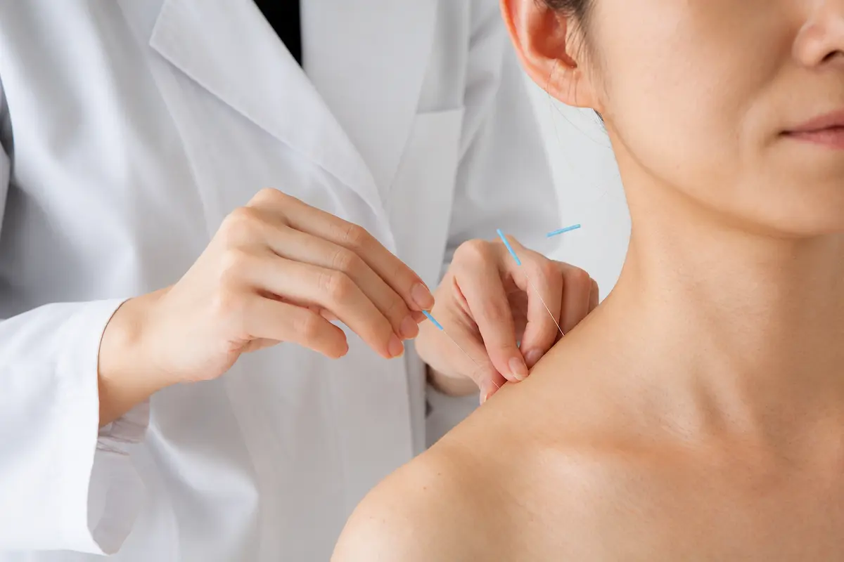 Close-up of acupuncture treatment for the neck and shoulder