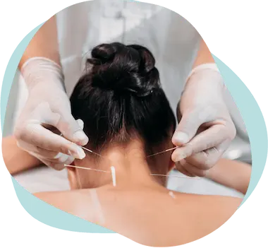 Practitioner inserting acupuncture needles into the back of a woman’s neck during treatment
