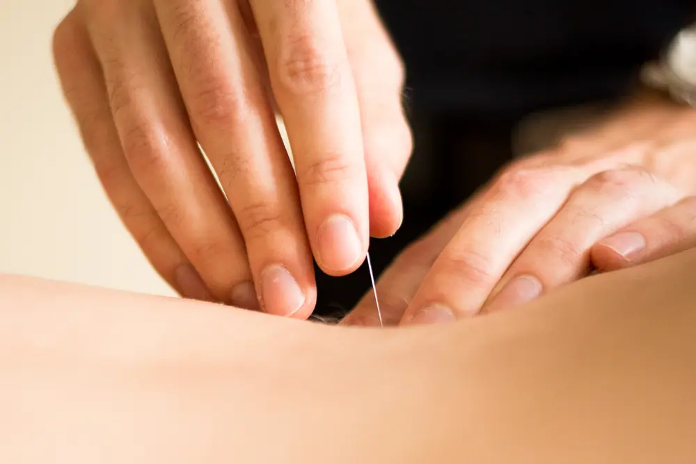 Acupuncturist inserting a fine needle during acupuncture therapy in East Setauket NY
