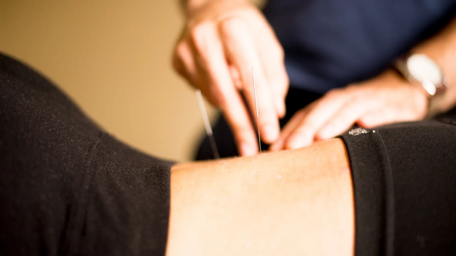 Close-up acupuncture treatment on the arm in Setauket