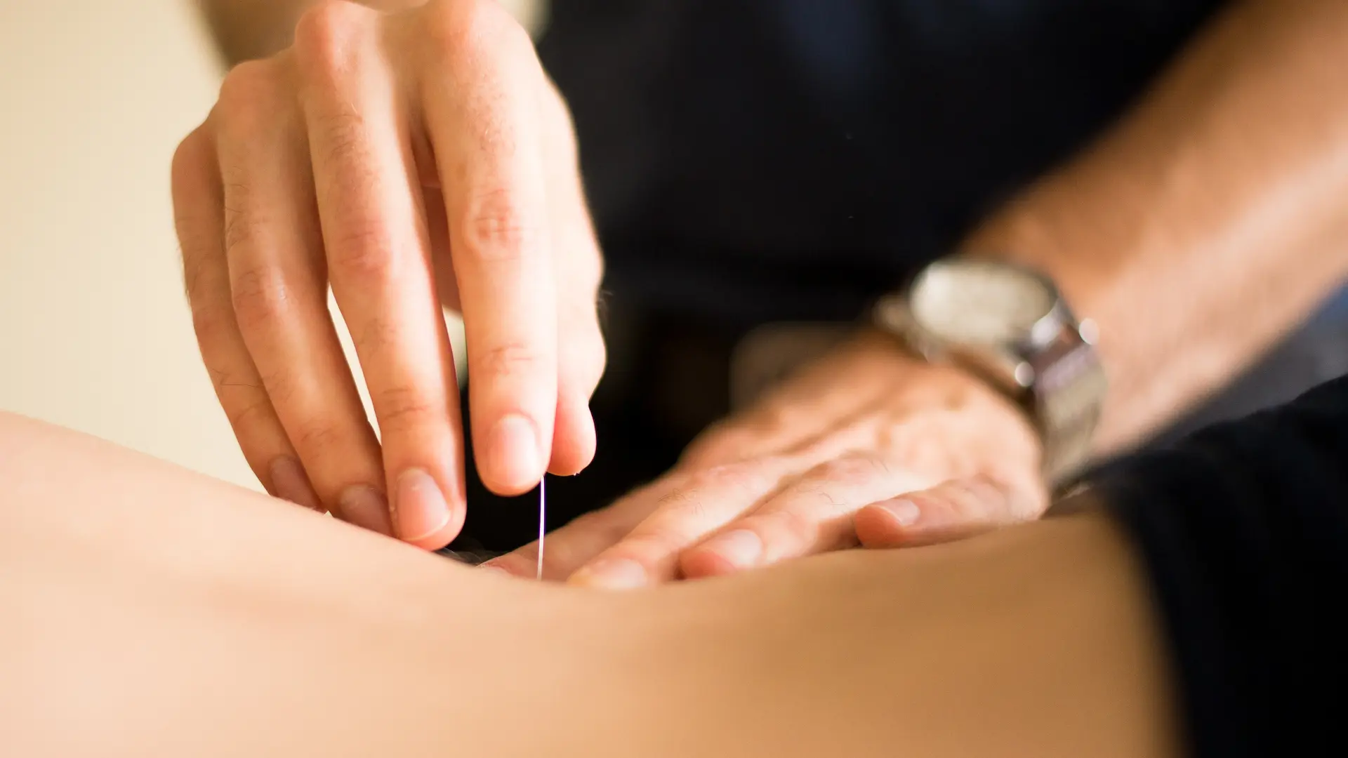 Acupuncturist inserting a thin needle into a patient’s back during treatment