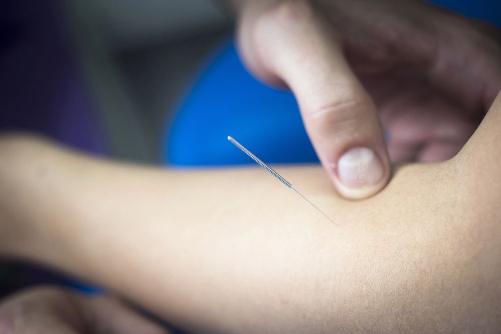 Can Dry Needling Help Manage Golfers’ Elbows?