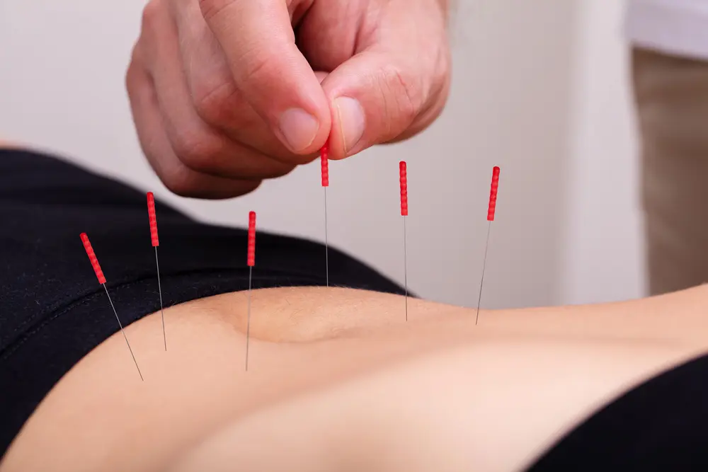 Acupuncture needles inserted in the abdomen for digestive health and stress relief in East Setauket NY