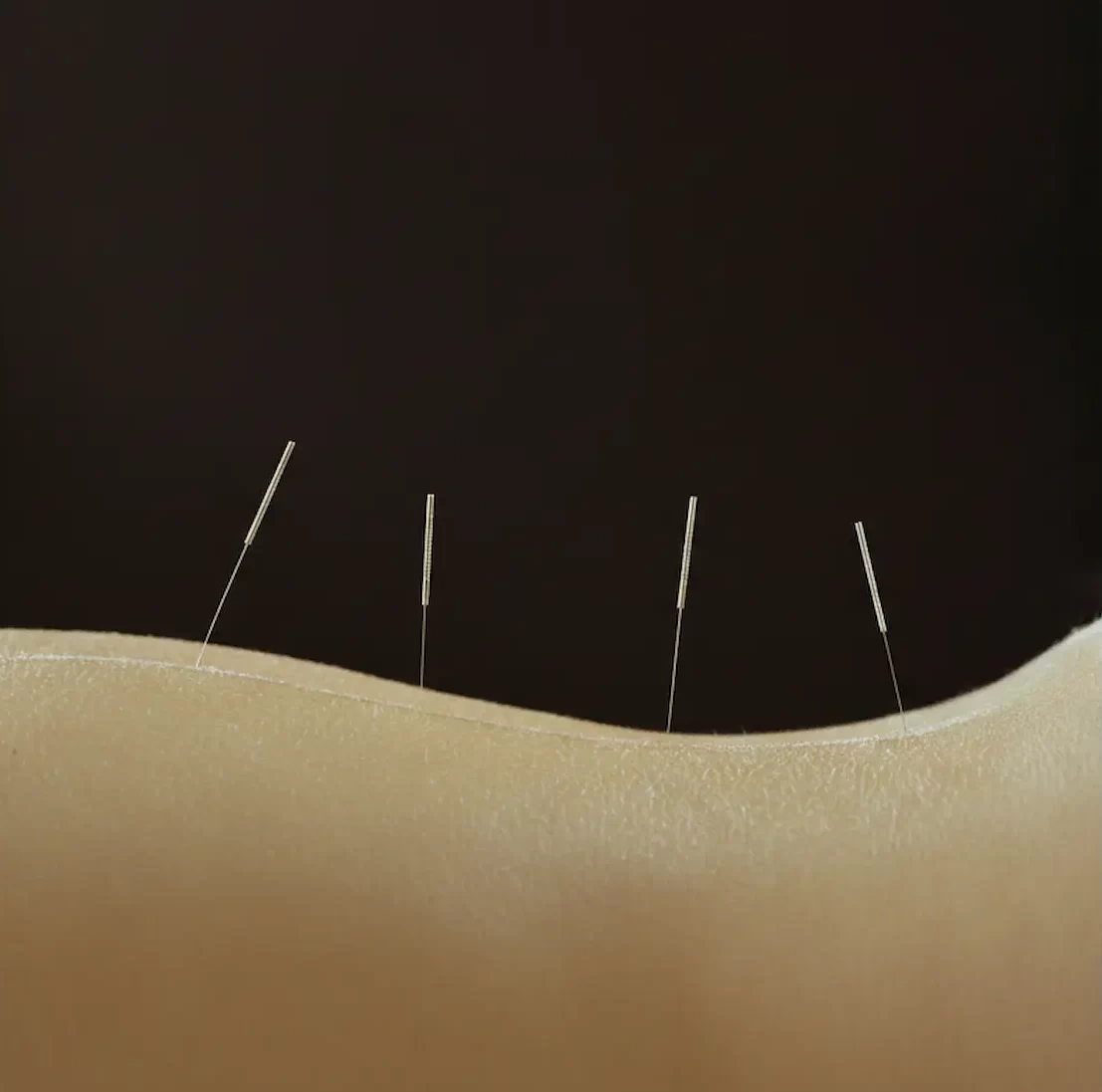 A close-up of a practitioner's hand performing acupuncture for holistic health by placing needles along the spine to balance body energy.