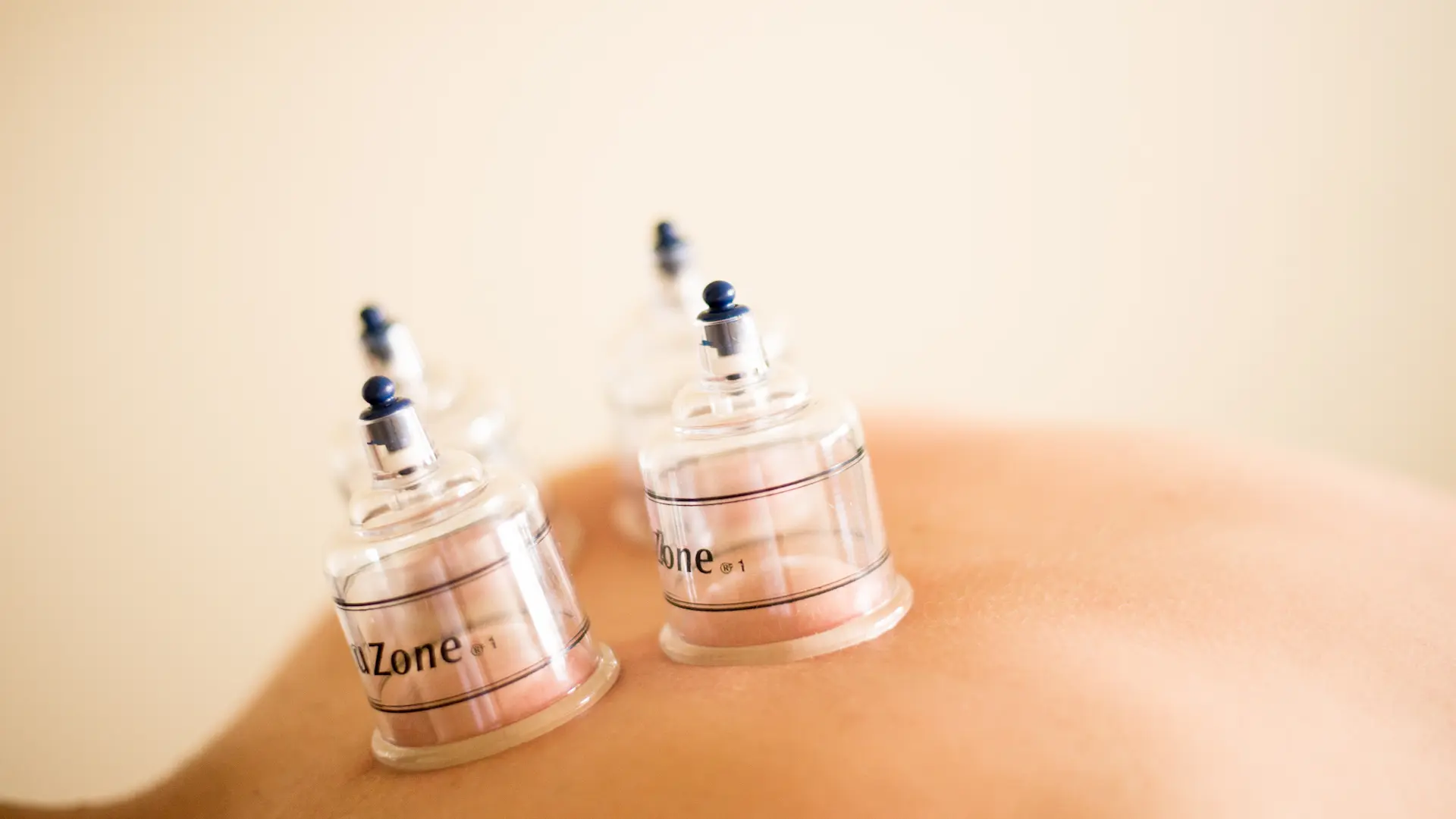 Cupping therapy for muscle tension at Messina Acupuncture PC