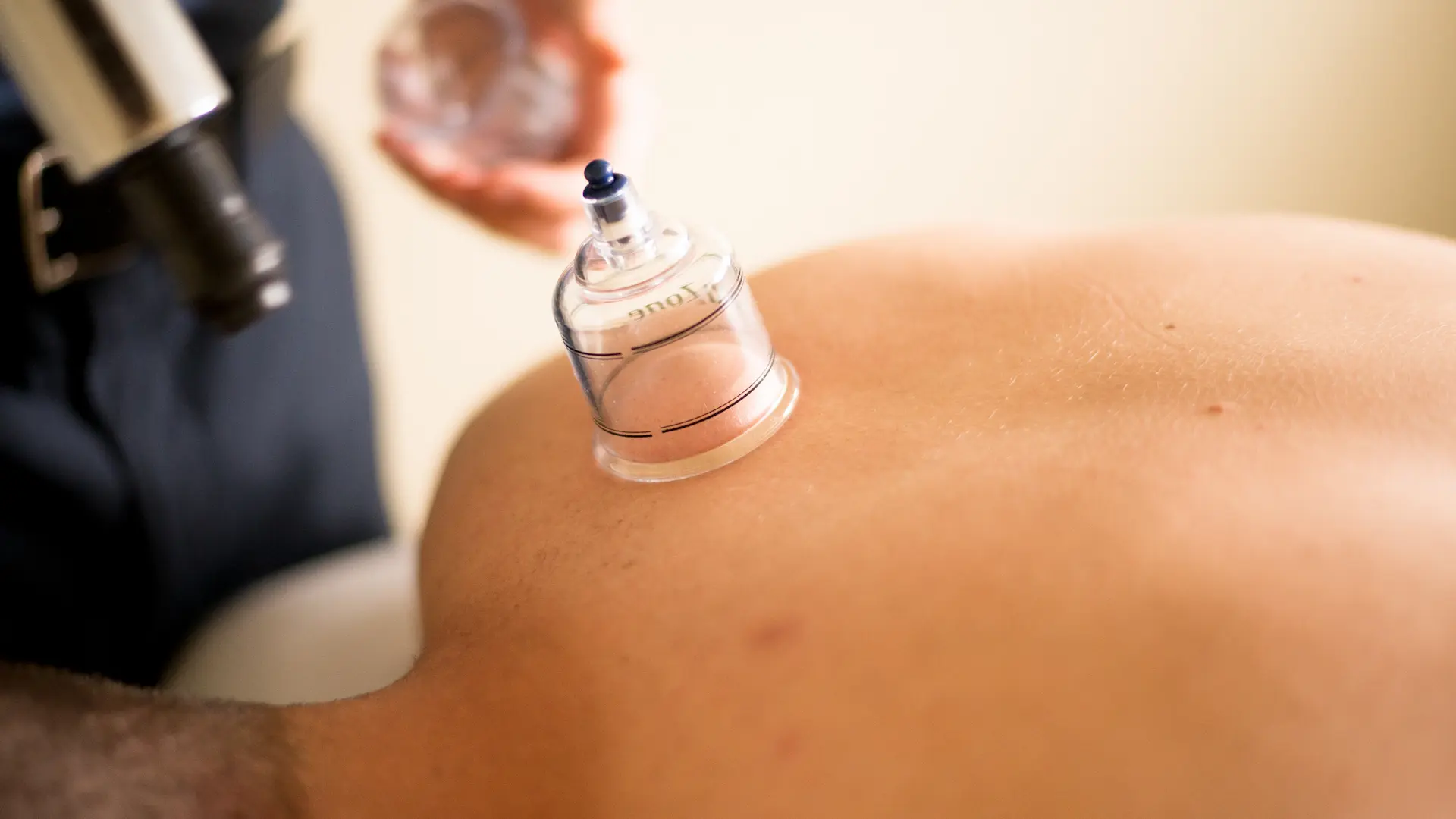 Cupping therapy on a patient back at Messina Acupuncture PC
