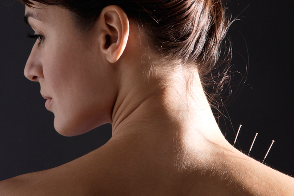 Dry Needling For Neck Pain: Everything You Need To Know