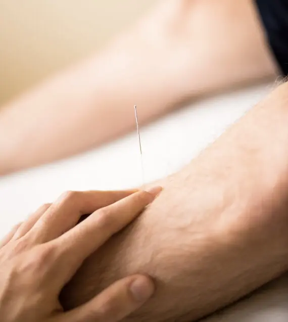 Dry needling therapy applied to the leg to relieve pain, reduce muscle tension, and support recovery at Messina Acupuncture PC in East Setauket NY
