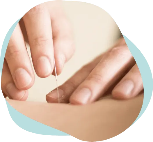 Dry needling therapy applied to relieve muscle pain, trigger points, and tension at Messina Acupuncture PC in East Setauket NY