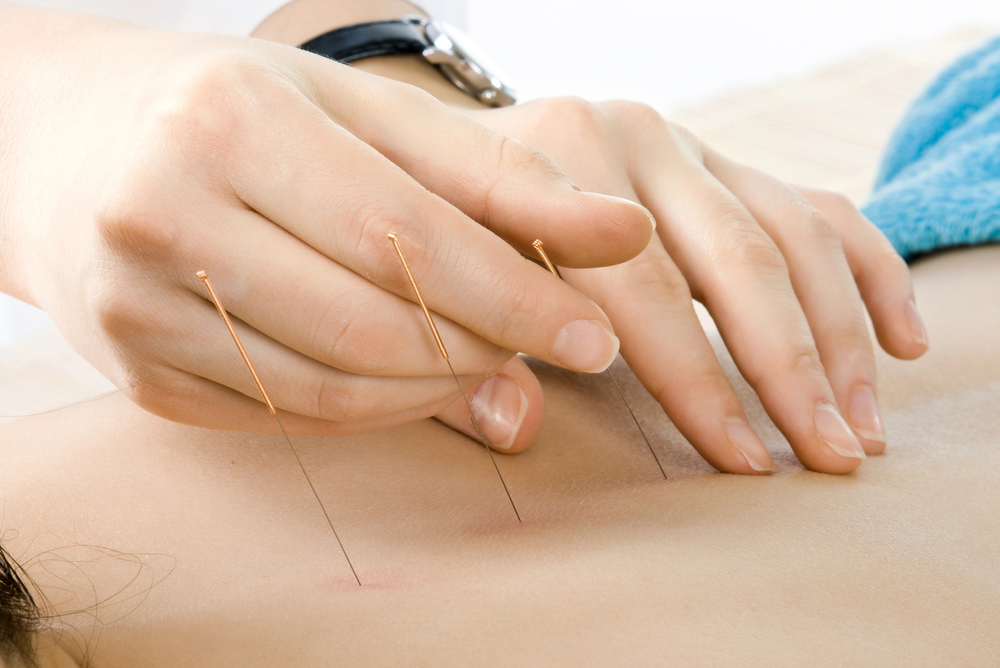 Dry Needling Therapy: How Does It Actually Work?