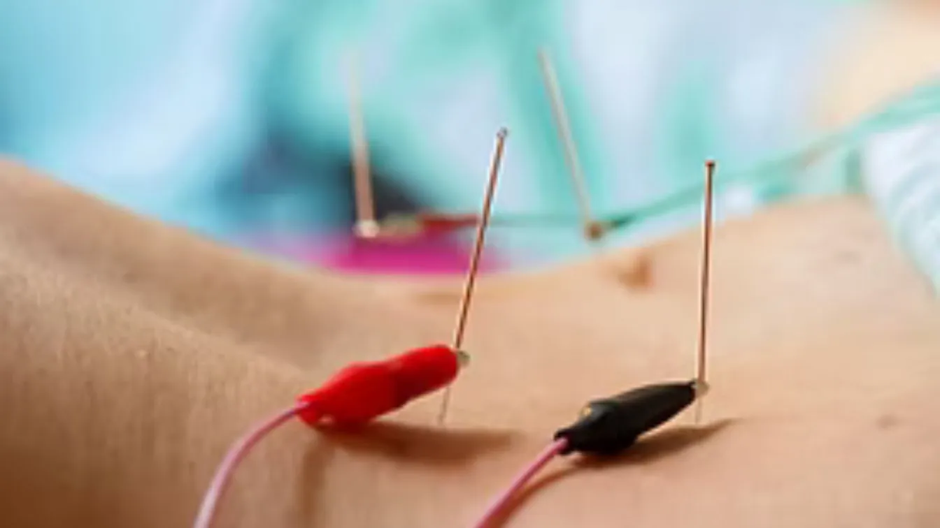 Electroacupuncture needle and lead placement during musculoskeletal treatment in East Setauket