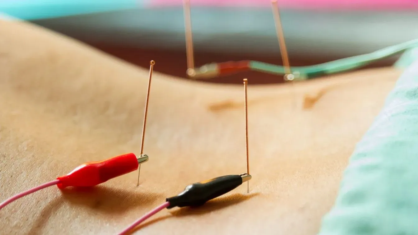 Close-up of acupuncture needles used during electroacupuncture treatment