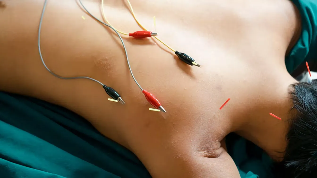 Electroacupuncture treatment for pain relief in Setauket NY