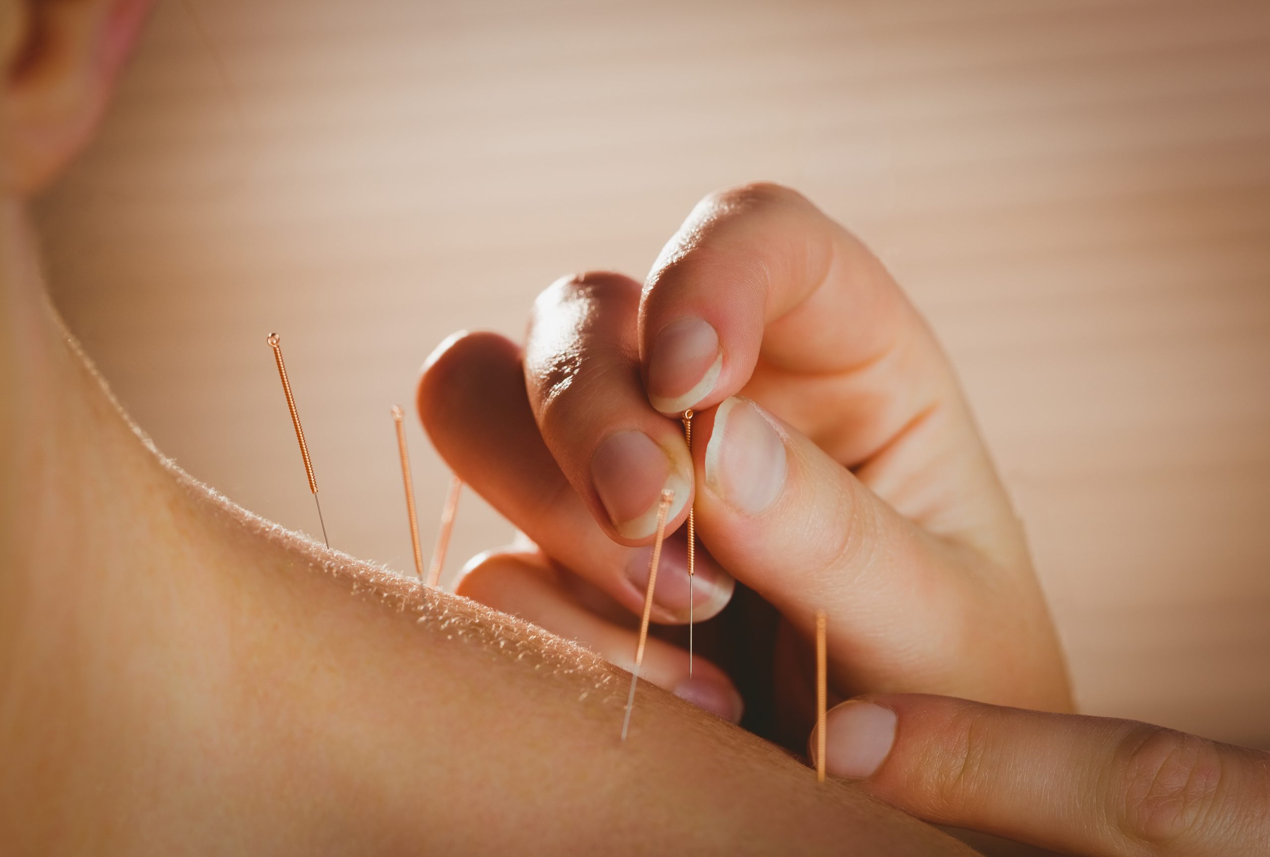 Young woman getting acupuncture treatment in therapy room