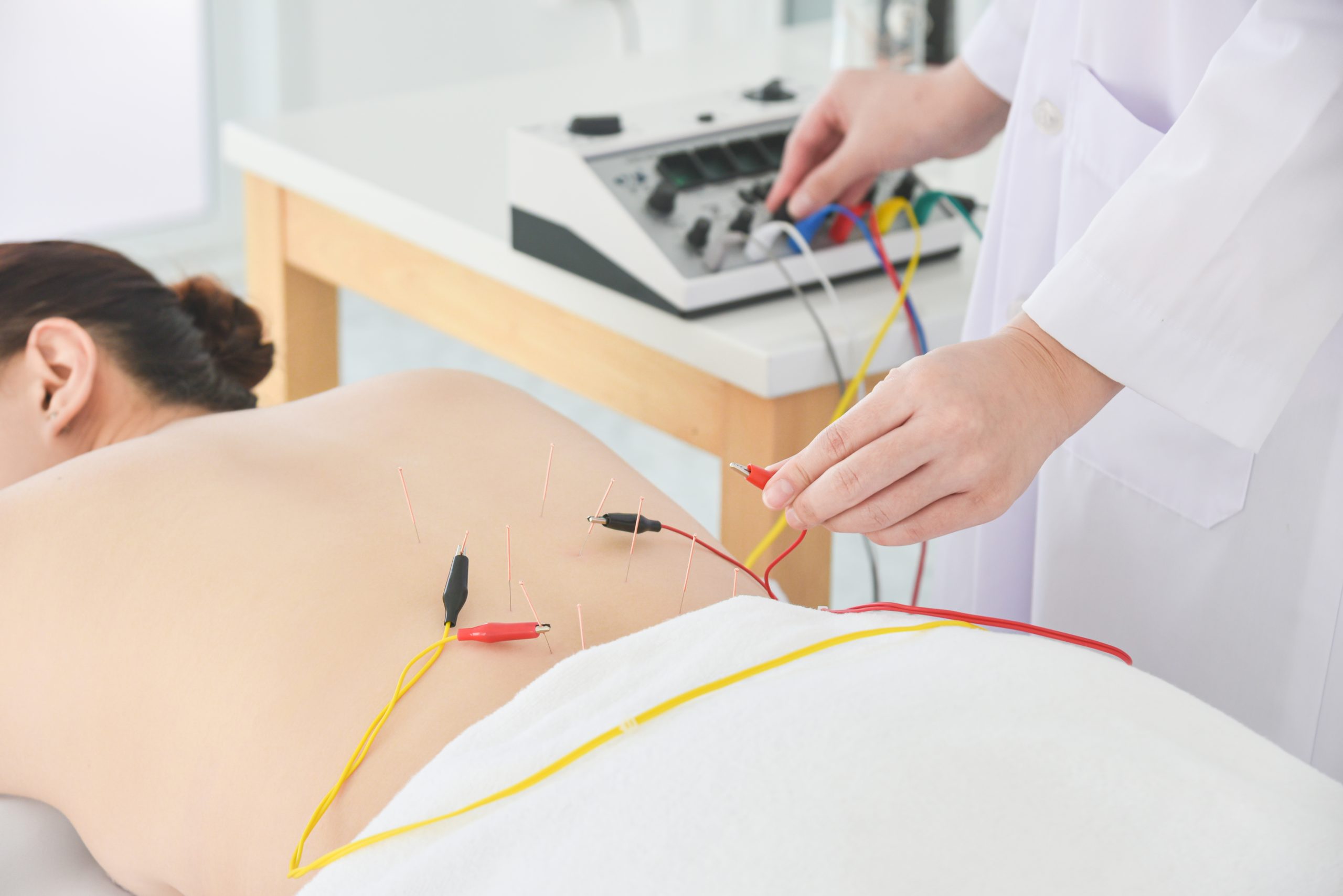 Asian woman receiving acupuncture with electrical stimulator at