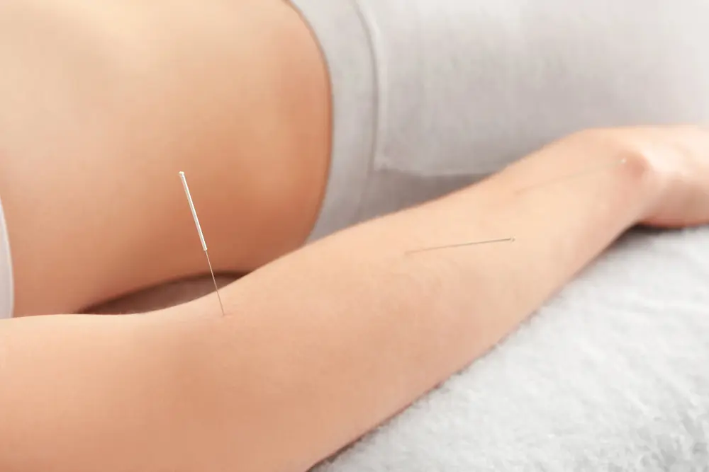 Acupuncture needles in the arm for tennis elbow treatment in East Setauket NY