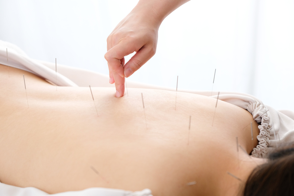How Effective Is Dry Needling For Back Pain Relief?