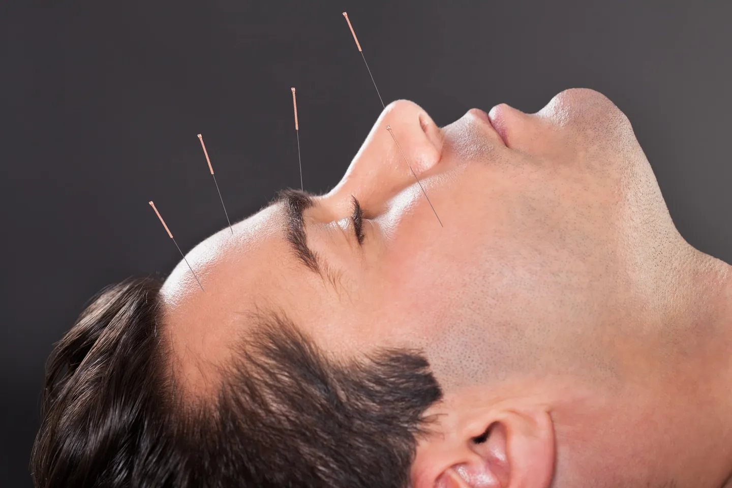 Acupuncture treatment for recurring headache and migraine patterns in East Setauket NY