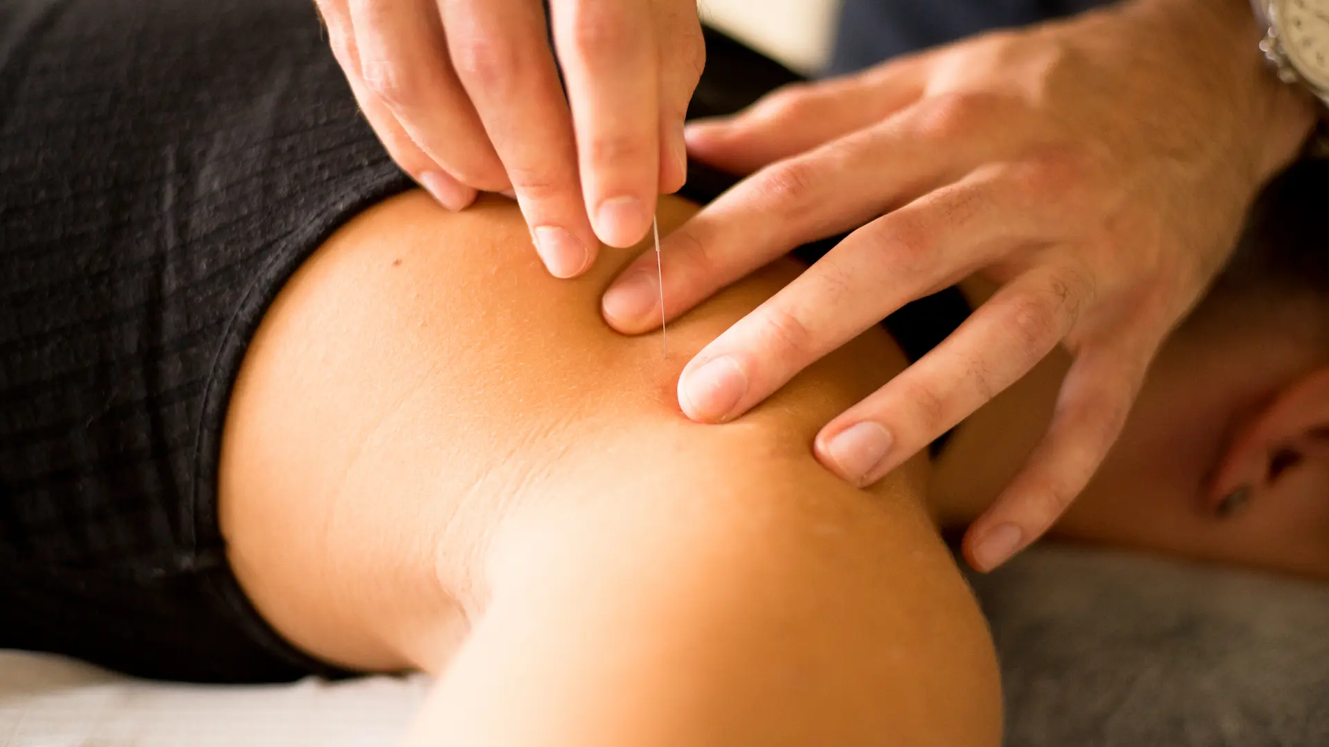 Practitioner inserting an acupuncture needle into a patient’s shoulder