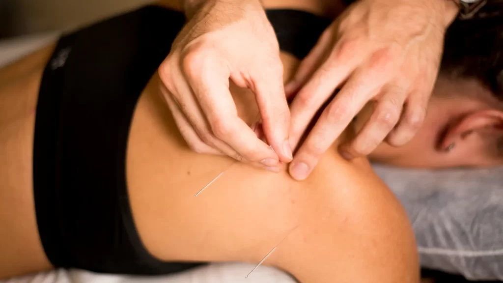 What Not to Do After Acupuncture: An Evidence-Based Aftercare Guide 1 Practitioner performing acupuncture on shoulder muscles