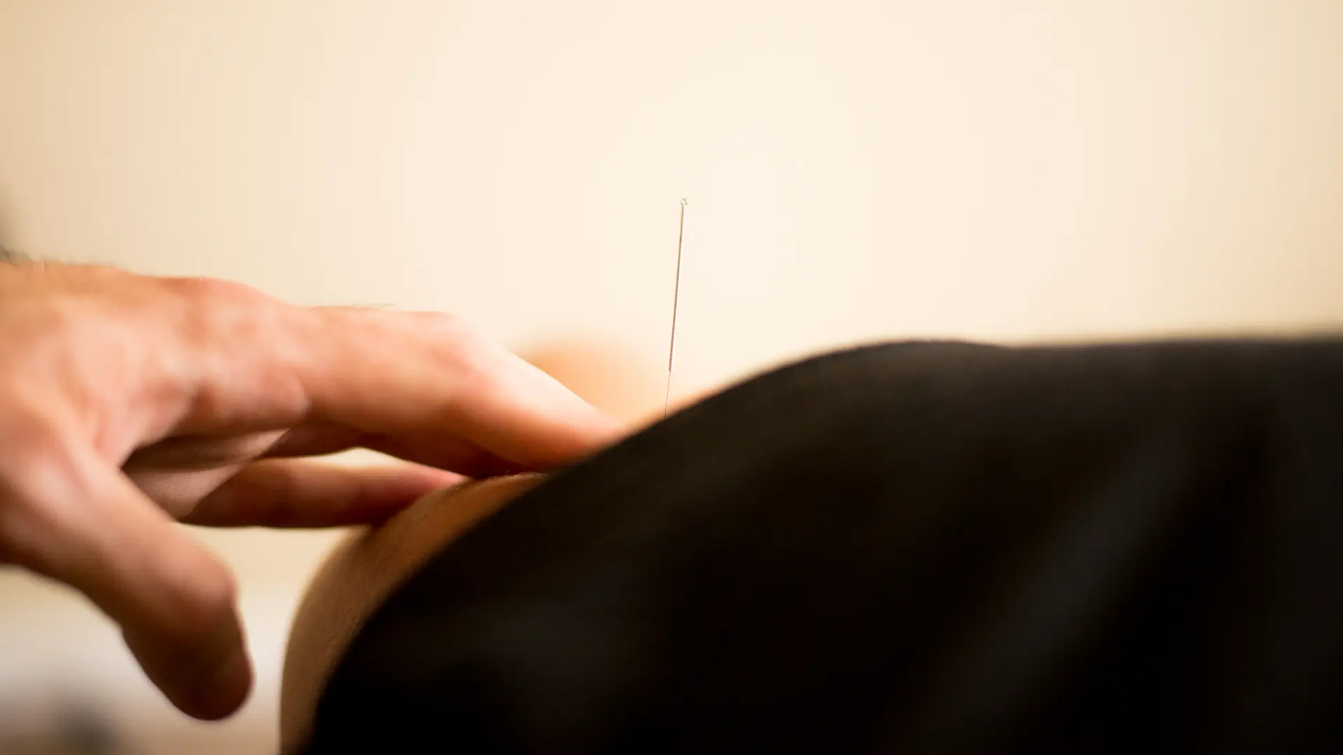 Acupuncture treatment at Messina Acupuncture PC in East Setauket, New York