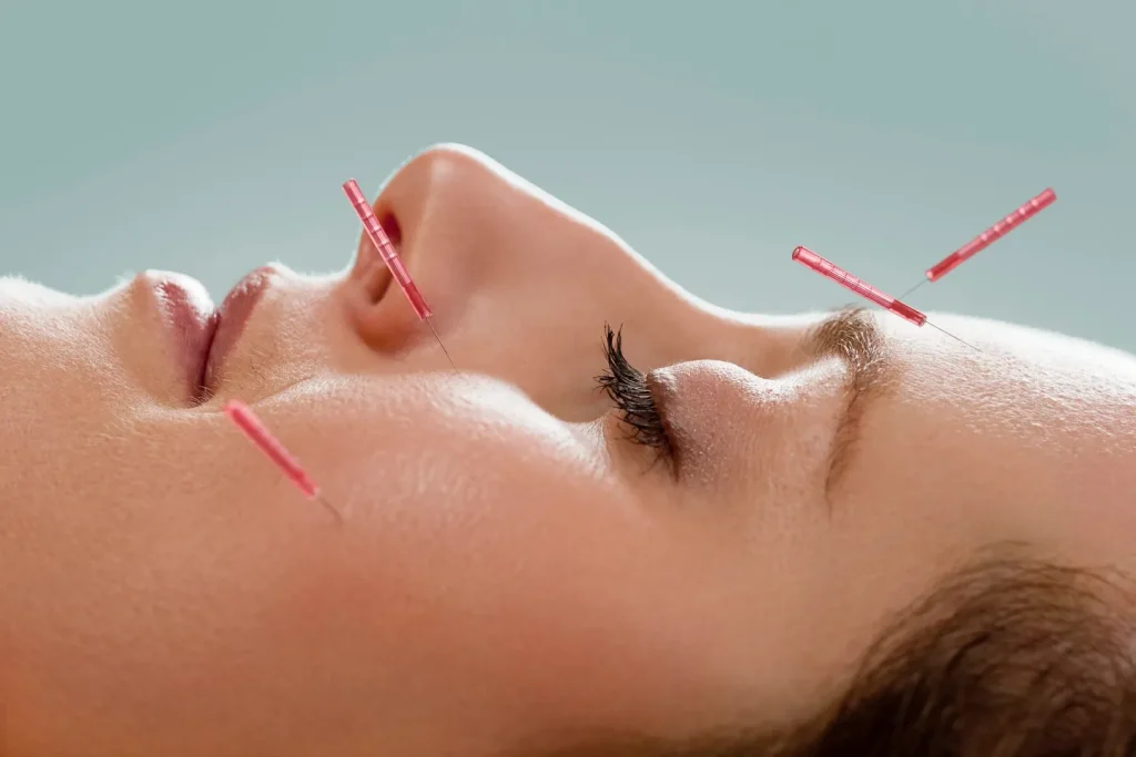 Acupuncture treatment supporting relief from sinus pressure and headache symptoms