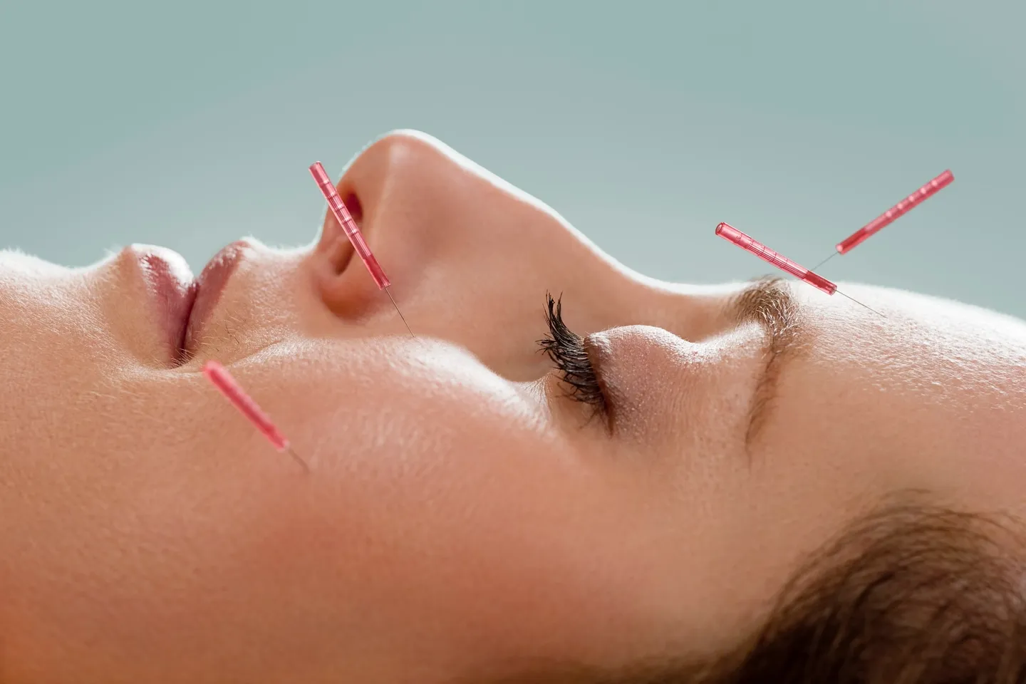 Acupuncture treatment supporting relief from sinus pressure and headache symptoms