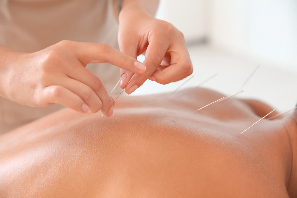 Understanding The Effects Of Dry Needling For Fibromyalgia