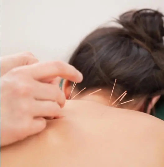 Acupuncturist inserting needles into the upper back and neck for pain and tension relief in East Setauket NY