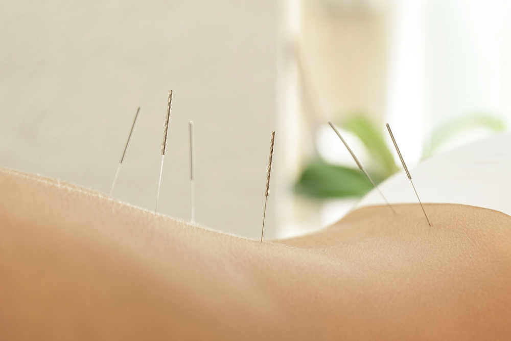 What To Do Before Acupuncture