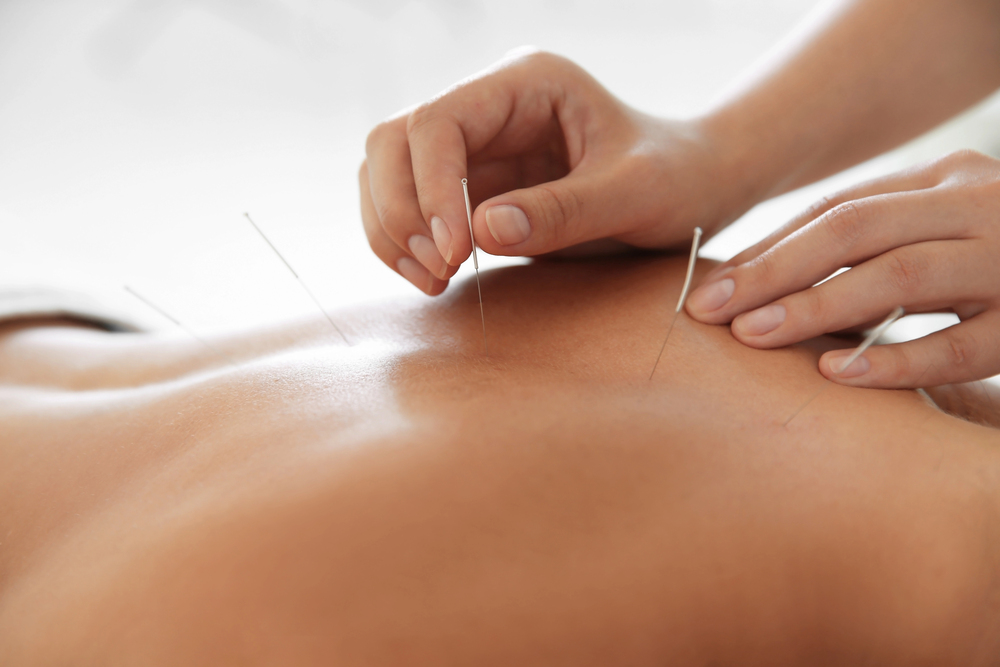 5 Ways Dry Needling Provides Relief For Sciatic Nerve Pain